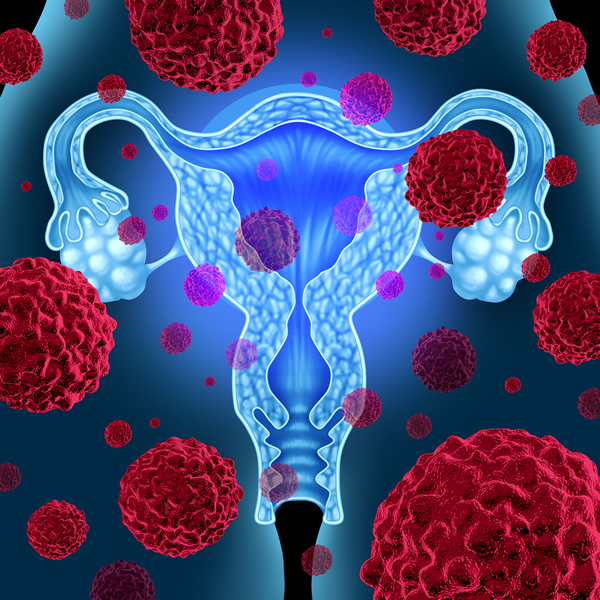 基因组分析显示：卵巢癌有7种疾病亚群