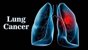 国外肺癌靶向药来势汹汹，能撼埃克替尼霸主地位否？