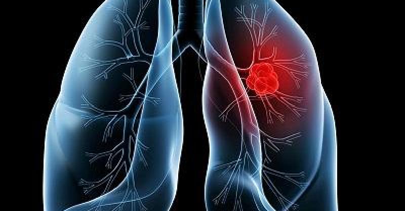 FDA批准新疗法，治疗BRAF突变非小细胞肺癌