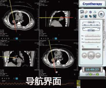 新博医疗获华医资本领投1.2亿A轮融资，主推介入手术导航系统