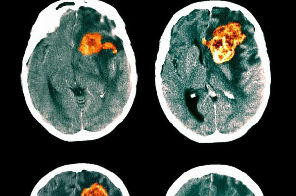 CAR-T疗法治疗胶质母细胞瘤首次成功穿越血脑屏障