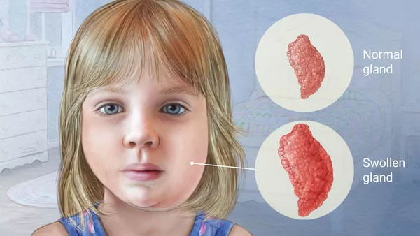 不讲理的腮腺炎