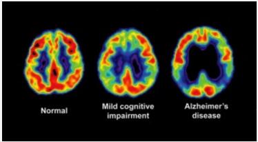 造化弄人！被称为阿尔兹海默氏病元凶的β淀粉样蛋白竟有可能是大脑的抗菌斗士