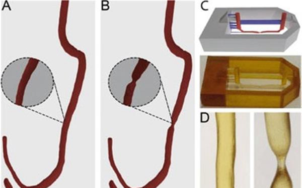 研究员3D打印微流体血管模型，研究动脉血栓的形成原因