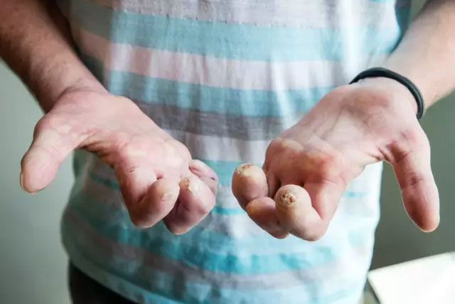 一个家族的百年抗争 有望造福数百万名患者