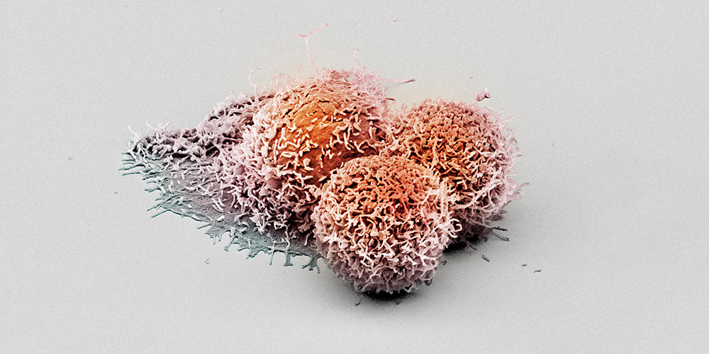 Nature：全新的肿瘤抑制蛋白LHPP，可阻止癌细胞在肝脏组织中扩散