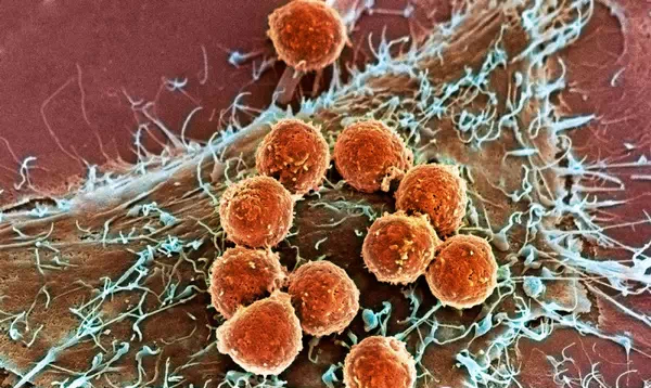 卵巢癌靶向治疗的那些事儿