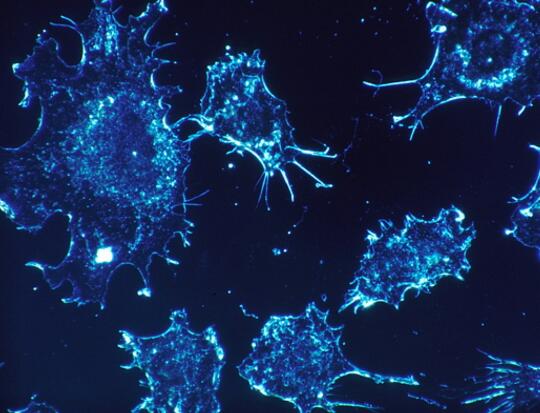 恶性肿瘤“天生就坏”？