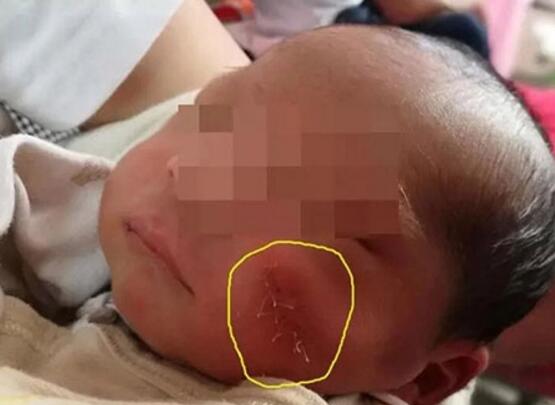剖宫产婴儿脸部被划伤缝8针，手术医生被停职
