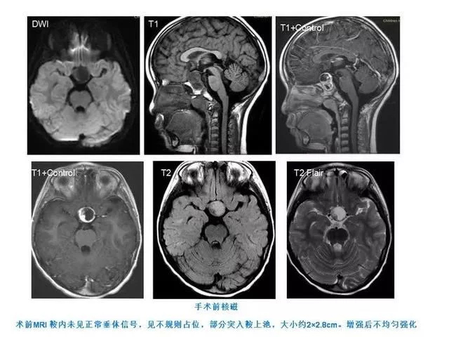 国内首例经鼻内窥镜下儿童颅咽管瘤切除手术成功