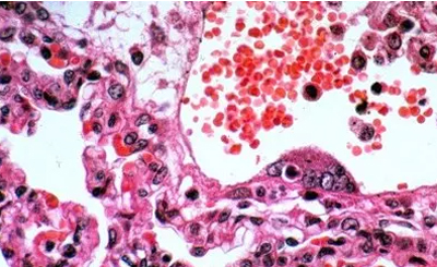 印度爆发无法治愈的罕见致命新病毒