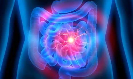 一文读懂溃疡性结肠炎的诊断与治疗