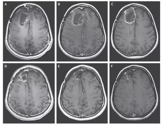 突破！病毒疗法将致命脑瘤3年生存率提高5倍！