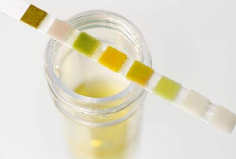 一滴尿能预测糖尿病恶化情况