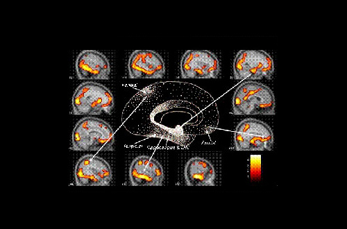 屡败屡战？Anavex携“一石三鸟”新疗法入阿尔茨海默氏症战争