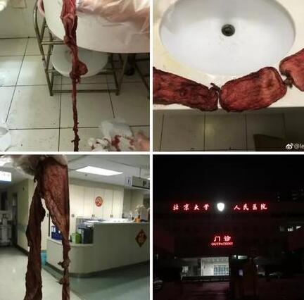 产妇剖腹产三天后排出纱布，北大人民医院这样回应......