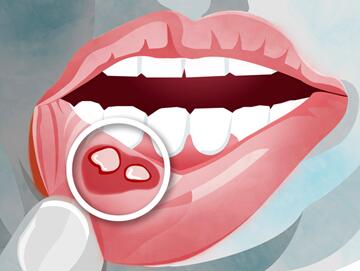 肿瘤放疗带来的副作用，马上就有新药可以预防了