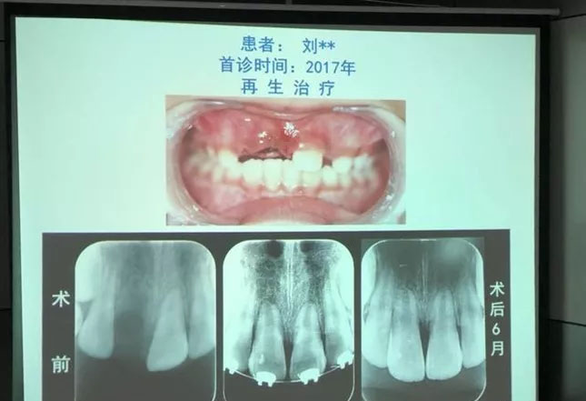 空军军医大学首创牙髓再生术，临床有效率超95%
