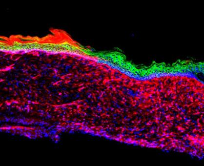 不用移植了！新研究将溃疡面直接变为健康皮肤