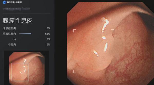 从癌症检测到刷脸支付，腾讯 AI “跑”出实验室