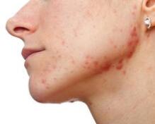 痤疮新药3期数据喜人，有望成为首款非口服局部疗法