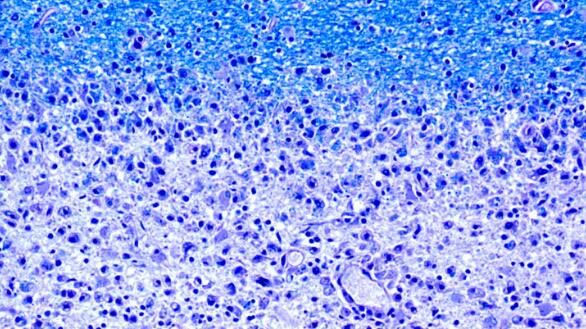 肠道菌群或和多发性硬化症发生直接相关