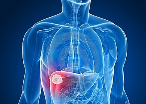 Nature综述：肝癌的治疗现状与未来