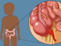 割阑尾或降低患帕金森综合症风险