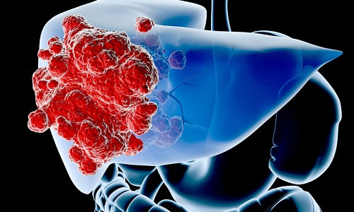 2018年肝癌市场分析：免疫单抗与抗血管药物的风云际会