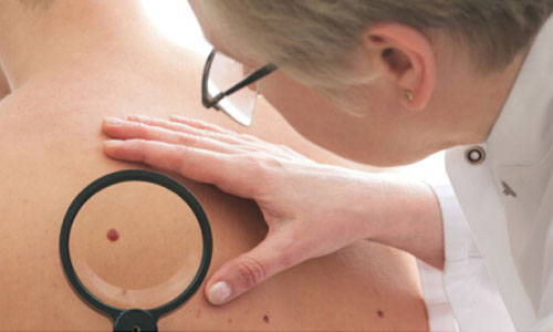 黑色素瘤治疗药物研究进展：30款已上市 44款处于临床3期