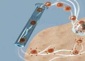 ASH | CAR-T疗法的这4大进展你都知道吗？