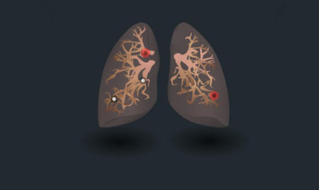 国家癌症中心：2018年全国最新肺癌报告