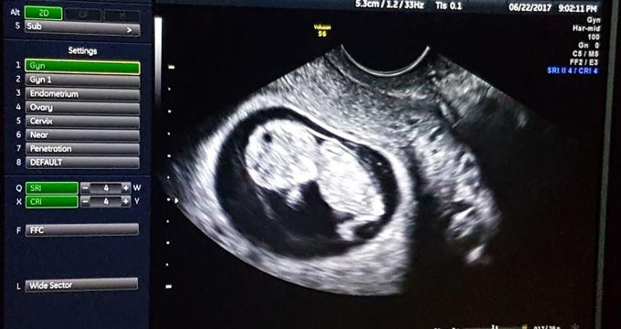 世界首个已故捐献者子宫移植孕育的婴儿诞生