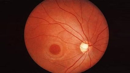 首次人体试验！美国将开展干细胞治疗黄斑变性