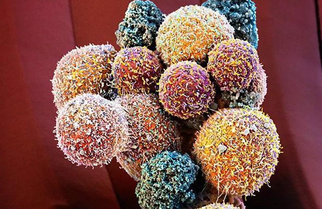 《细胞》公布癌症新疗法：药物可有效控制转移，乳腺癌成第一个实验对象