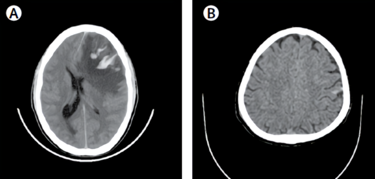 《柳叶刀》：人工智能可识别九类急性脑CT异常