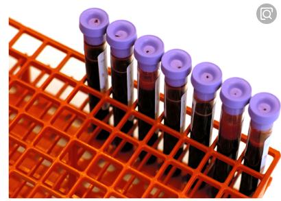 Nature：鉴定出用于预测肝脏中有毒脂肪累积的血液生物标志物