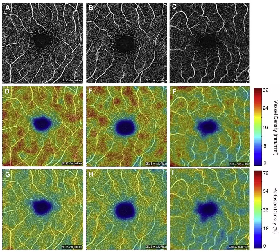 杜克大学最新研究：视网膜血管变化，透露阿尔茨海默症征兆？