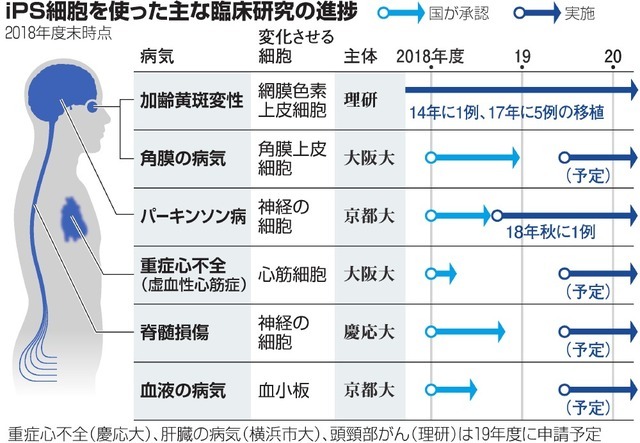 日本研究确认世界首个ips细胞异体移植手术安全性 但未大幅改善视力 医谷网