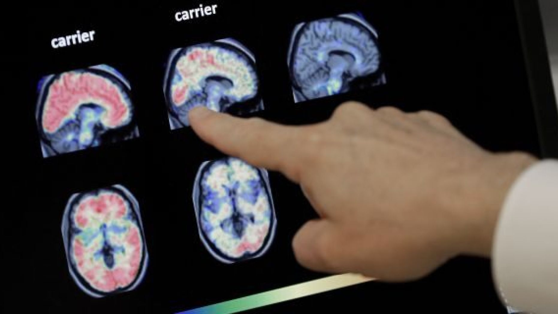 新研究揭示阿尔茨海默病患者脑细胞变化