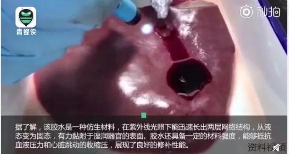 新型生物胶水数秒止住大动脉出血遭知名医生质疑