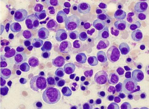 多发骨髓瘤市场拥挤 要如何突出重围？