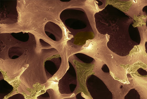 首款SO靶点骨质疏松症新药Romosozumab获批上市
