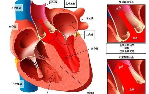 方兴未艾的中国介入心脏瓣膜市场：供应能力与高价等因素仍压制需求