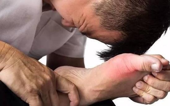 新研究揭示痛风的遗传风险因素