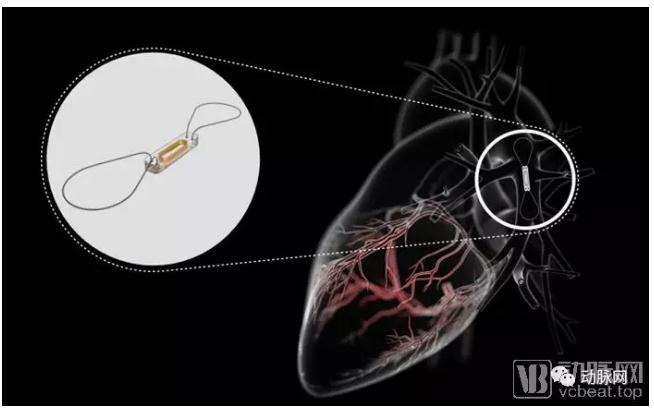 心衰作为心血管最后的战场，如何带来千亿市场空间