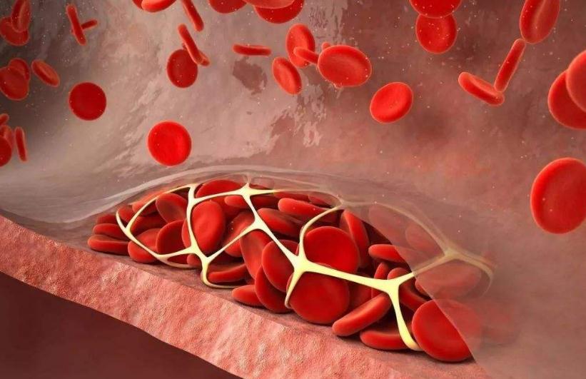 医院如何大幅提升VTE防治效率？1800余位专家达成这一共识……