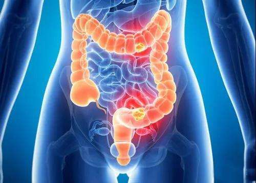 结直肠腺瘤癌变基因图谱绘出