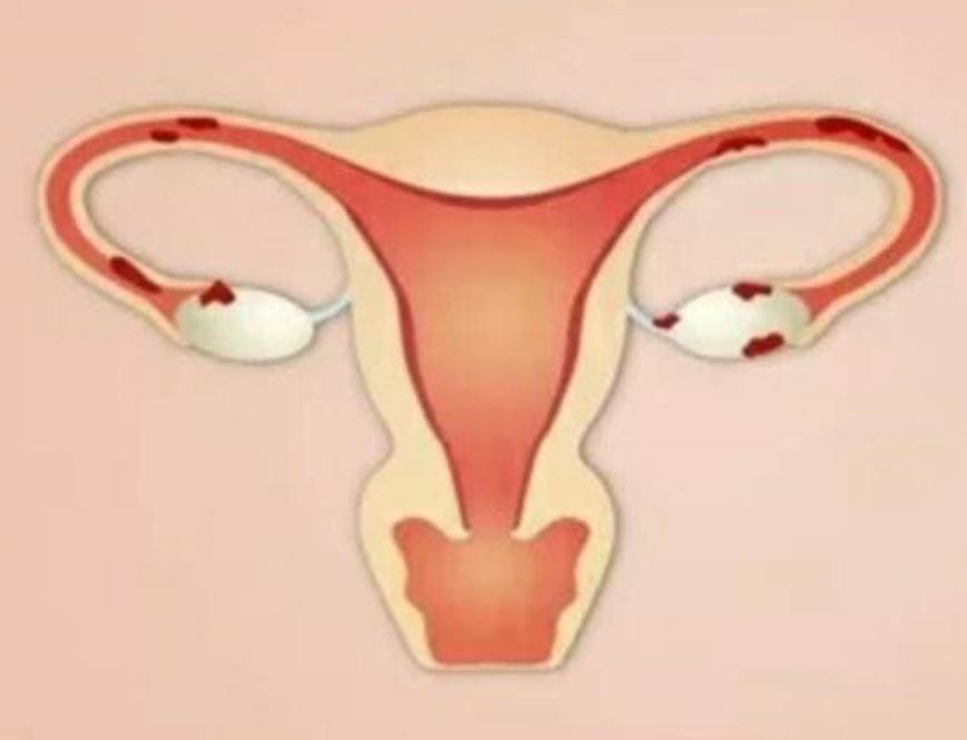 我国首个本土卵巢癌创新药获批上市！