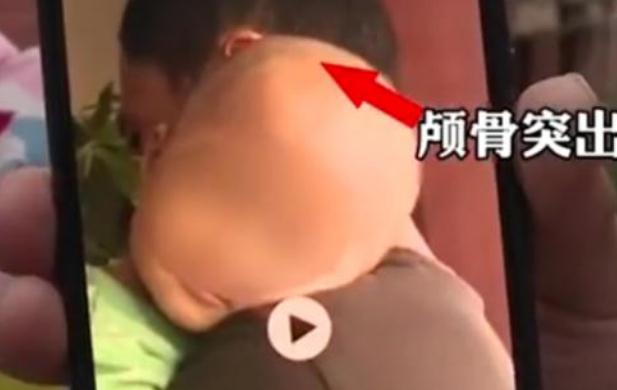 从郴州“大头娃娃”事件看背后的特医食品